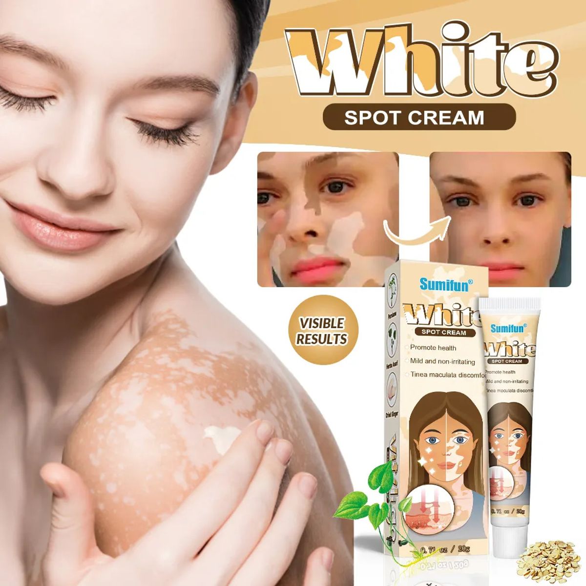 Sumifun White Spot Cream, Vitiligo Removal Cream 20g Sumifun White Spot Cream, Vitiligo Removal Cream 20g