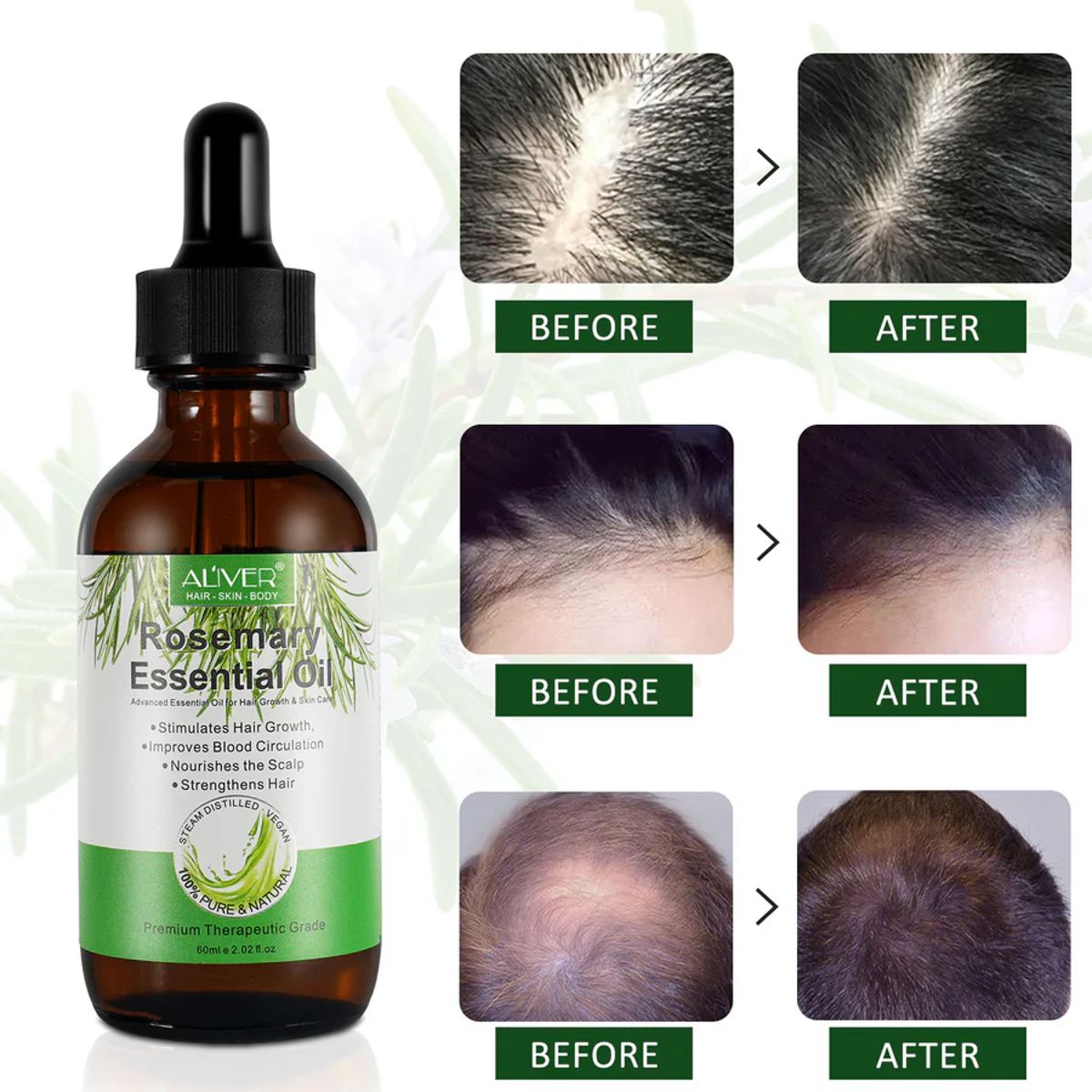 Aliver Rosemary Oil for Hair Growth