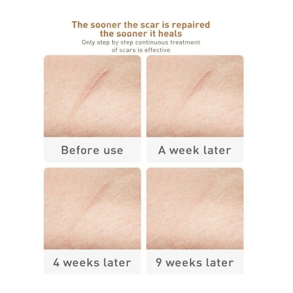 Lanbena Scar and Acne Mark Removal Gel Ointment 30g