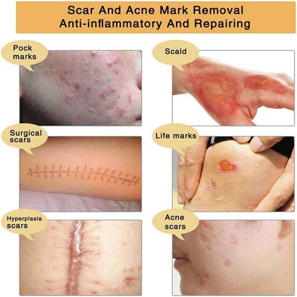 Aliver 30g TCM Scar and Acne Mark Removal Gel Ointment