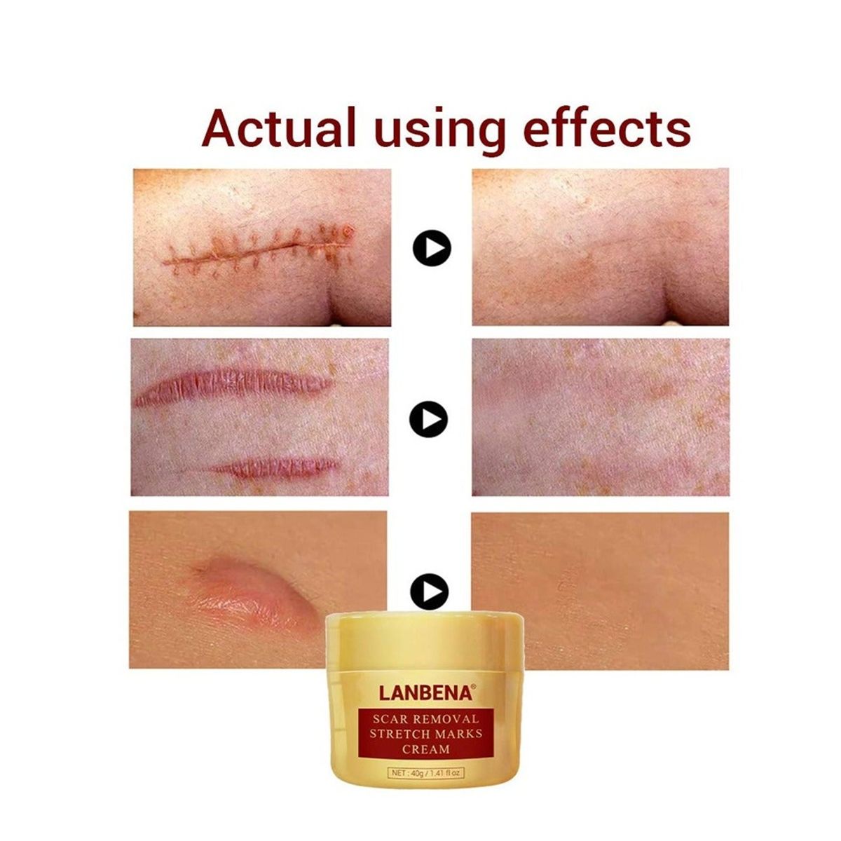 Lanbena Scar Removal Stretch Marks Cream 40G