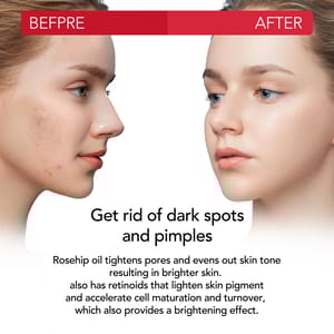 Aliver Rosehip Oil For Face, Hair & Body