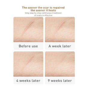 Lanbena Scar and Acne Mark Removal Gel Ointment 30g